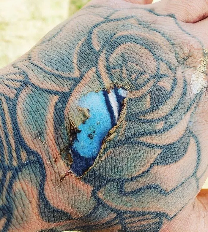 Epidermal Burn Of The Hand Exposes Bright Colors Of Tattoo Ink Embedded In The Dermal Layer Of The Skin