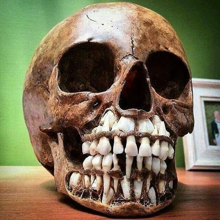 Cráneo de un niño con una parte de la mandíbula extraída para mostrar los dientes permanentes que se desarrollan debajo de los dientes deciduos (dientes de leche).