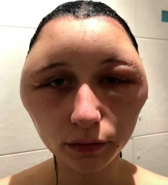 Hinchazón extensa de la cabeza debido a una reacción alérgica al tinte para el cabello