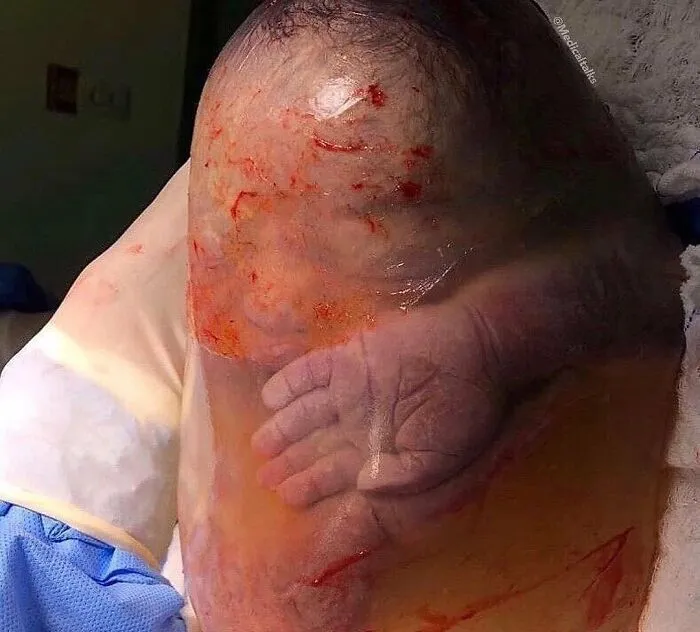 Bebé encerrado en un saco amniótico intacto