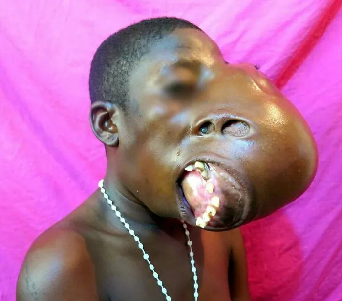 Case Of Craniofacial Fibrous Dysplasia