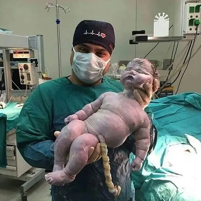 El bebé más grande por parto vaginal natural, con un peso aproximado de 7,9 kg y 57,5 cm de largo.