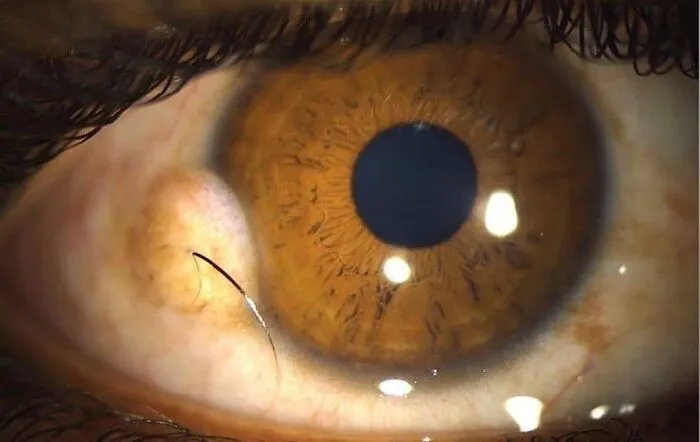 Cabello que crece en el ojo del paciente