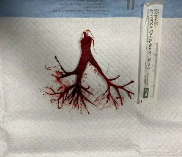 Coágulo de sangre intacto adherido al tubo endotraqueal de un paciente con COVID-19 terminalmente extubado