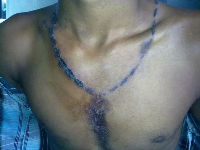 Cicatriz y quemadura en el pecho mostrando una imagen médica fascinante e inquietante de lesión en la piel.