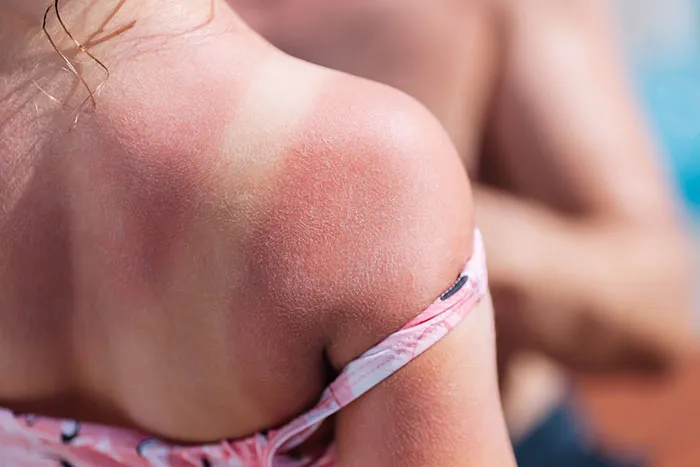 “They Put Duct Tape On Blistered Skin”: 50 Times Doctors Saved Patients From Their DIY Treatments