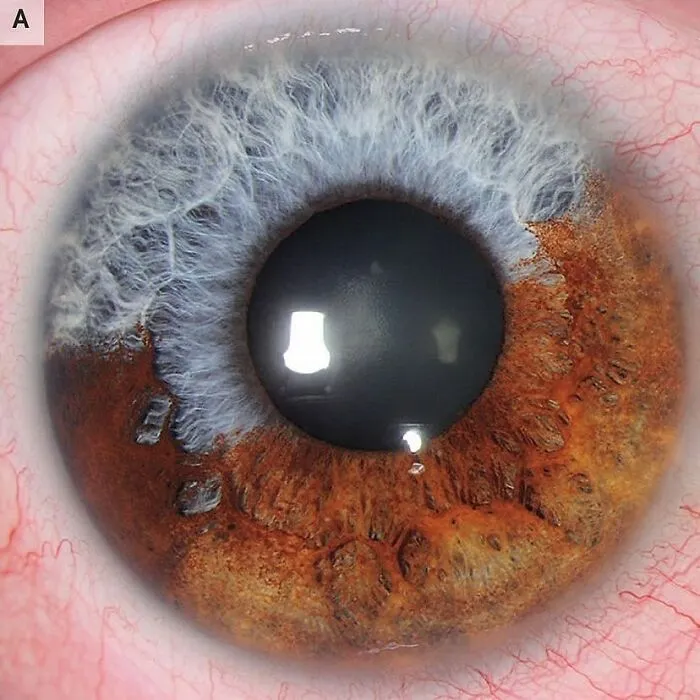 Ojo en primer plano mostrando detalles médicos y texturas del cuerpo en una imagen médica aterradora.