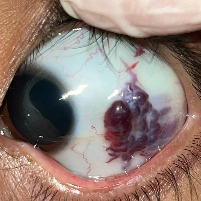 Ojo con hemorragia subconjuntival mostrando una condición médica impactante y cuerpo humano aterrador.