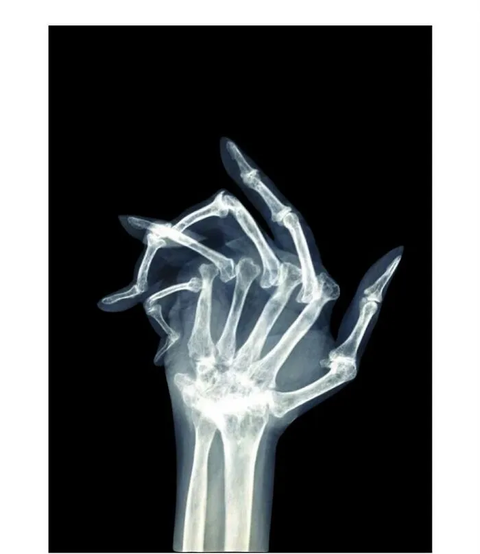 Radiografía médica que muestra deformidad ósea en la mano, una impactante imagen del cuerpo humano aterrador.