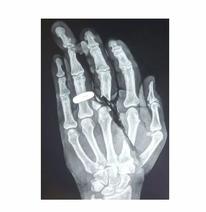 Radiografía de una mano con anillo y huesos fracturados, mostrando una imagen médica aterradora del cuerpo humano.
