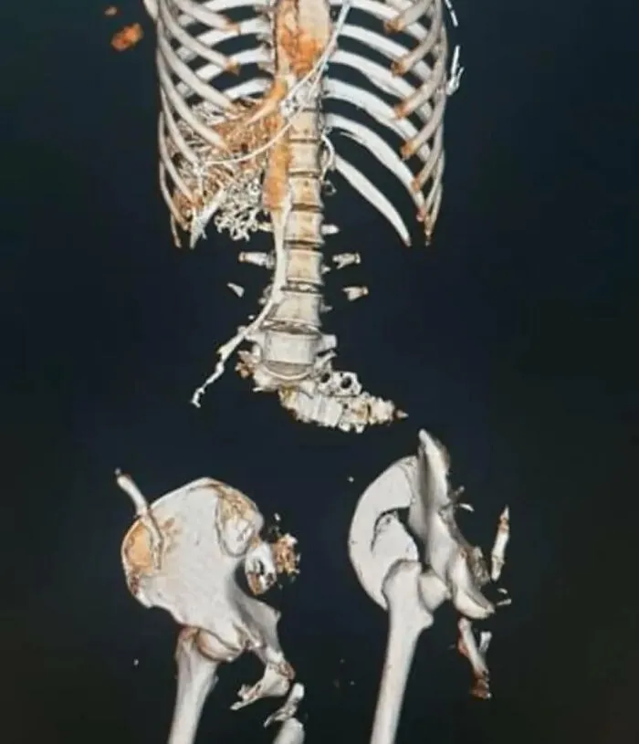 Radiografía médica que muestra fractura severa de columna y pelvis, demostrando que el cuerpo a veces es aterrador.