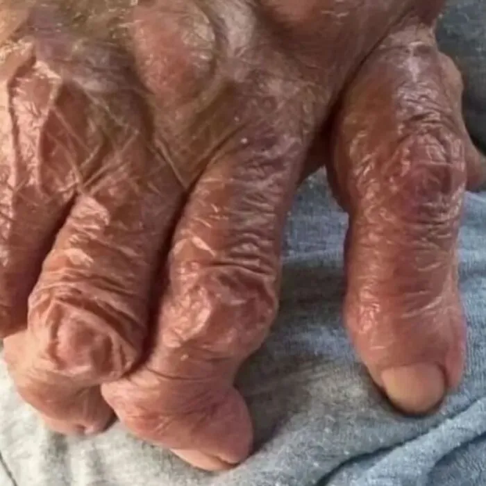 Mano con deformidades visibles y piel arrugada mostrando condición médica rara en fotos médicas aterradoras del cuerpo humano.