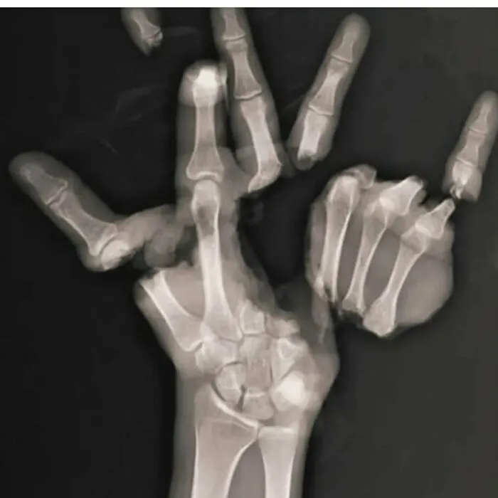 Radiografía médica mostrando deformación ósea intensa en mano humana, ilustrando el cuerpo a veces aterrador.