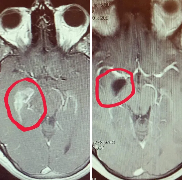 MRI brain scans showing before and after results with a marked area highlighting significant changes over time.