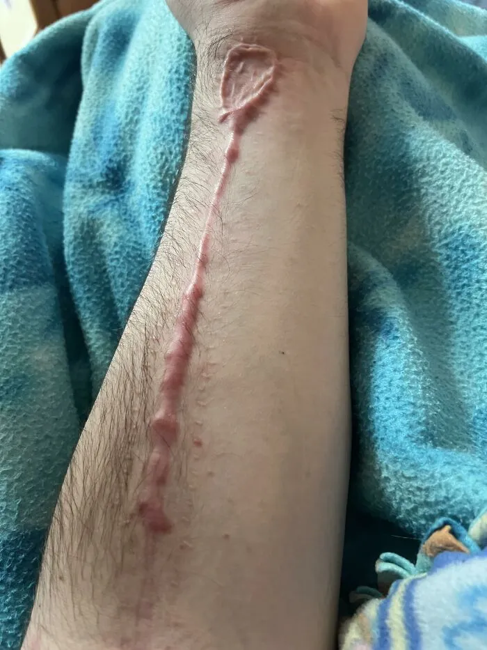 Close-up of a bizarre human body scar running along the forearm on light skin with blue fabric background.