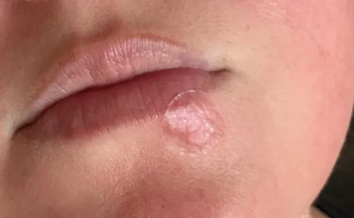 That Uninvited Guest On Your Lip Is About To Get A Polite But Firm Eviction Notice With A <a Style="Display:inline;" Href="Https://Www.amazon.com/Mederma-Cold-Discreet-Healing-Patch/Dp/B08mvf9yw1?ie=utf8&th=1&linkcode=ll1&tag=bppelican-20&linkid=84e4a8a693c3f3a47d73a4459b8686fd&language=en_us&ref_=as_li_ss_tl" Target="_blank"> <span Style="Font: Inherit; Color: #d74b1f;"> Fever Blister Discreet Healing Patch </Span>