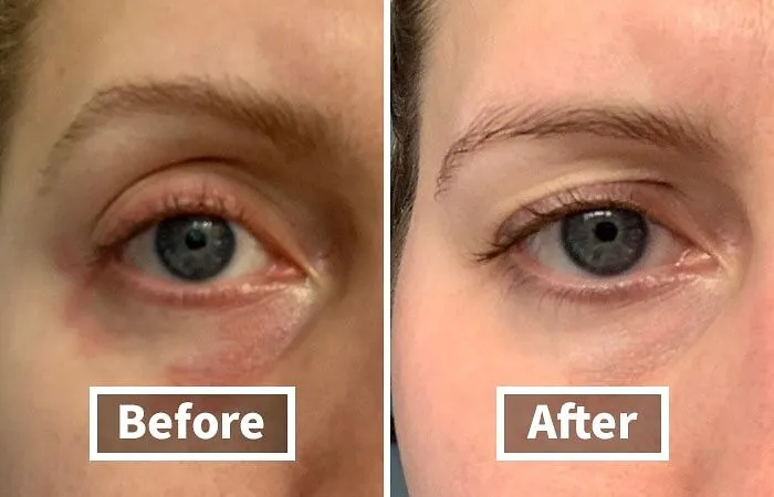 A Little Dab Of <a Style="Display:inline;" Href="Https://Www.amazon.com/Cetaphil-Hydrating-Gel-Cream-Hyaluronic-Acid/Dp/B07798mg7q?ie=utf8&linkcode=ll1&tag=bpbison-20&linkid=a2f02c01f5294472b7ceab1c4c66199f&language=en_us&ref_=as_li_ss_tl" Target="_blank">    <span Style="Font: Inherit; Color: #d74b1f;"> Cetaphil Hydrating Eye Gel-Cream </Span> Basically Serves Your Under-Eye Bags An Eviction Notice