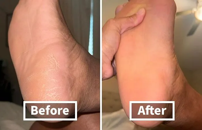 Tell The Dead Skin On Your Feet "Thank U, Next" With Some <a Style="Display:inline;" Href="Https://Www.amazon.com/Lee-Beauty-Professional-Strength-Pedicure/Dp/B01ncmjpoq?ie=utf8&th=1&linkcode=ll1&tag=bpbison-20&linkid=d52e5c9160759fca4b031523c1cd0c04&language=en_us&ref_=as_li_ss_tl" Target="_blank">    <span Style="Font: Inherit; Color: #d74b1f;"> Callus Remover Gel </Span>