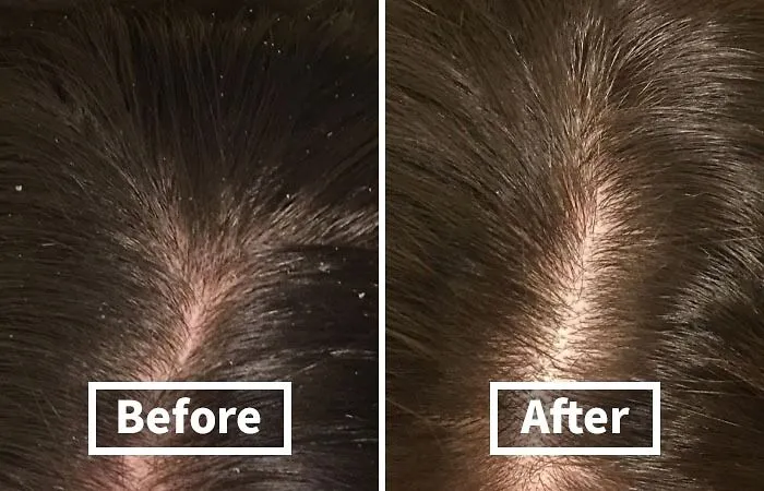 That Uninvited Snowstorm Happening On The Shoulders Of Your Favorite Black Shirt Can Be Officially Cancelled By <a Style="Display:inline;" Href="Https://Www.amazon.com/Nizoral-Anti-Dandruff-Shampoo-Ketoconazole-Dandruff/Dp/B00ainmfac?ie=utf8&th=1&linkcode=ll1&tag=bpfish-20&linkid=e6498b080c7f54848b38b71b64a2c900&language=en_us&ref_=as_li_ss_tl" Target="_blank">    <span Style="Font: Inherit; Color: #d74b1f;"> Nizoral Anti-Dandruff Shampoo </Span>