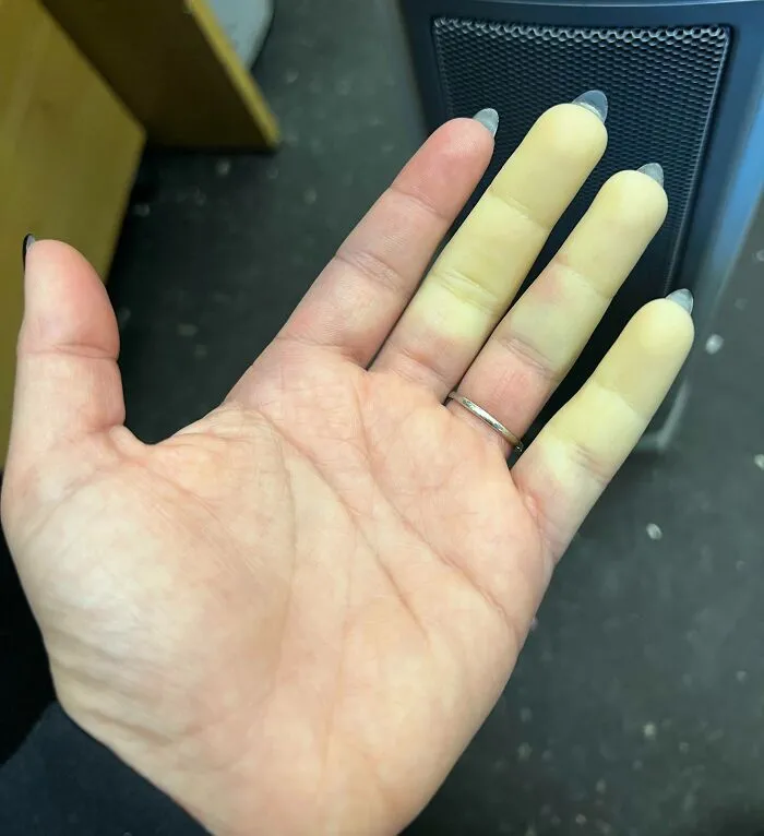 Síndrome de Raynaud en mi mano esta mañana
