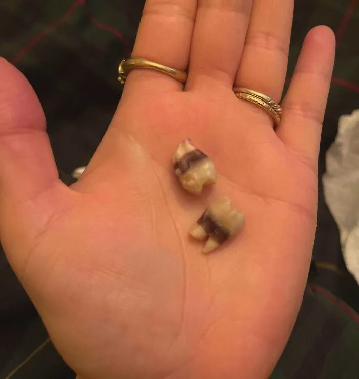 Mano con dos dientes humanos extraídos mostrando detalles curiosos del cuerpo humano.