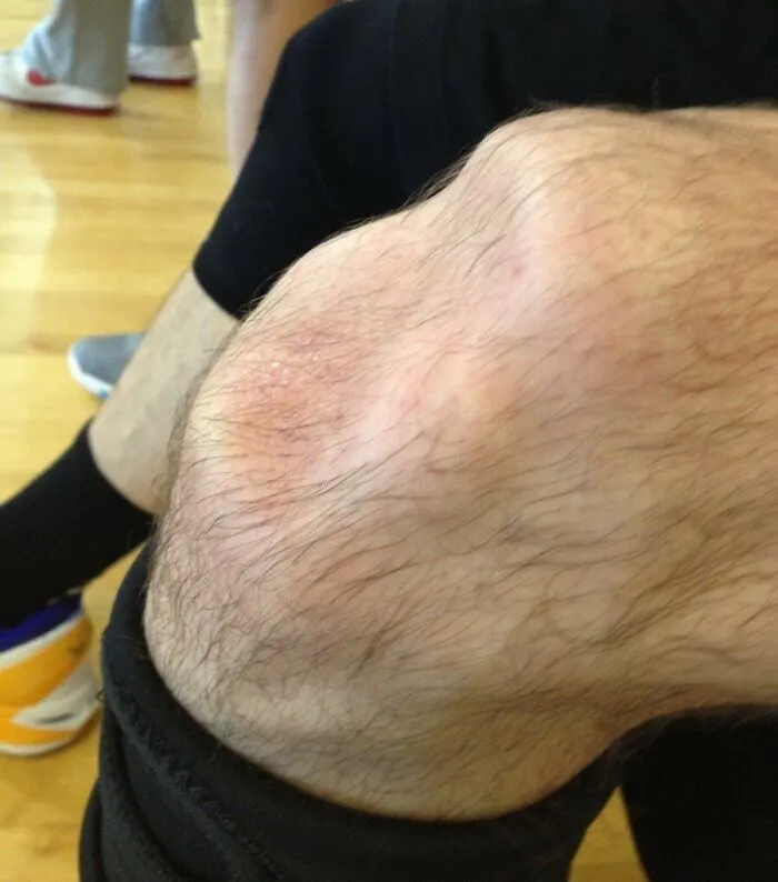 Así se veía mi rodilla después de intentar saltar y escuchar un chasquido