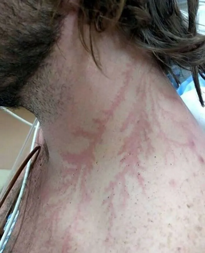 Ser alcanzado por un rayo puede dejar una marca o cicatriz similar a un tatuaje conocida como figura de Lichtenberg.