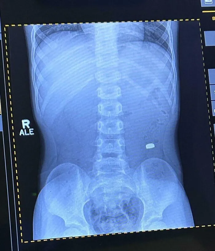 Radiografía del abdomen mostrando objeto extraño en el cuerpo, ejemplificando padres y madres teniendo un día peor que el tuyo.