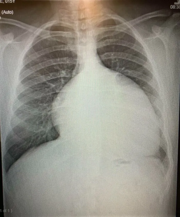 Mi corazón agrandado a los 15 años (2012) antes de las cirugías