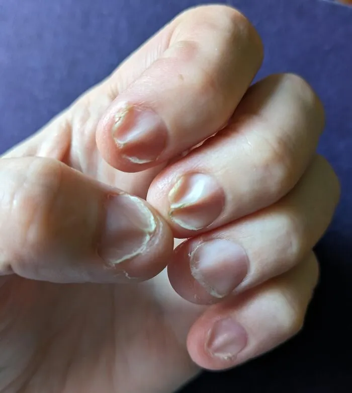 Mis uñas están arrugadas y bastante quebradizas