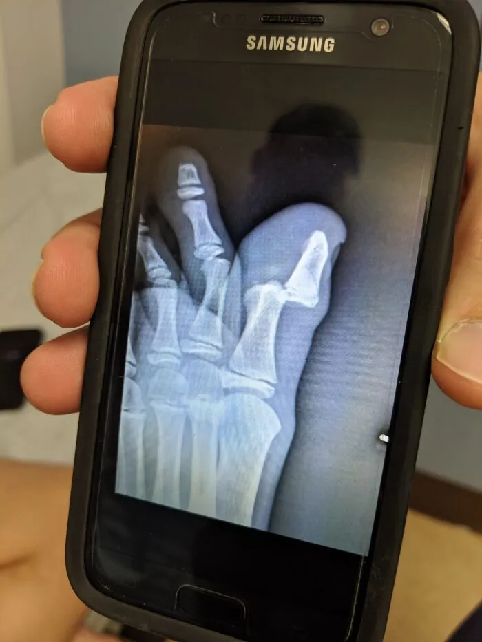 Radiografía en pantalla de móvil mostrando huesos rotos del dedo, ilustrando padres y madres teniendo un día peor.