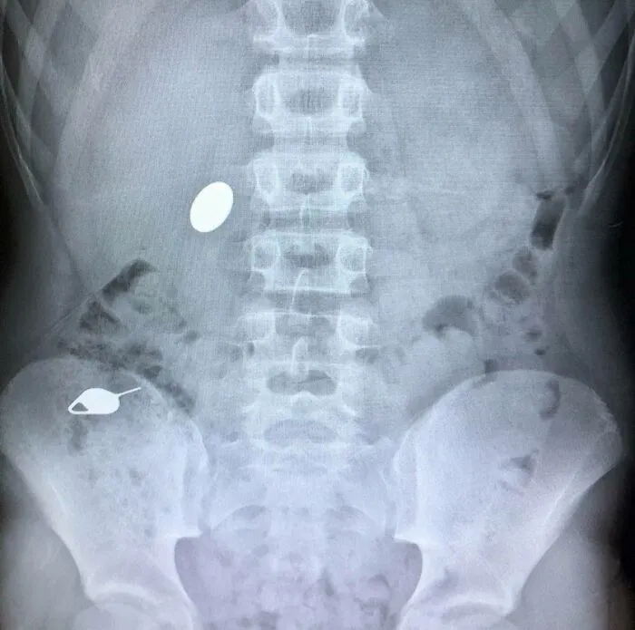Mi hijo se tragó un centavo mientras le mostraba a su hermano pequeño cómo se había tragado accidentalmente una clave SIM el día anterior.