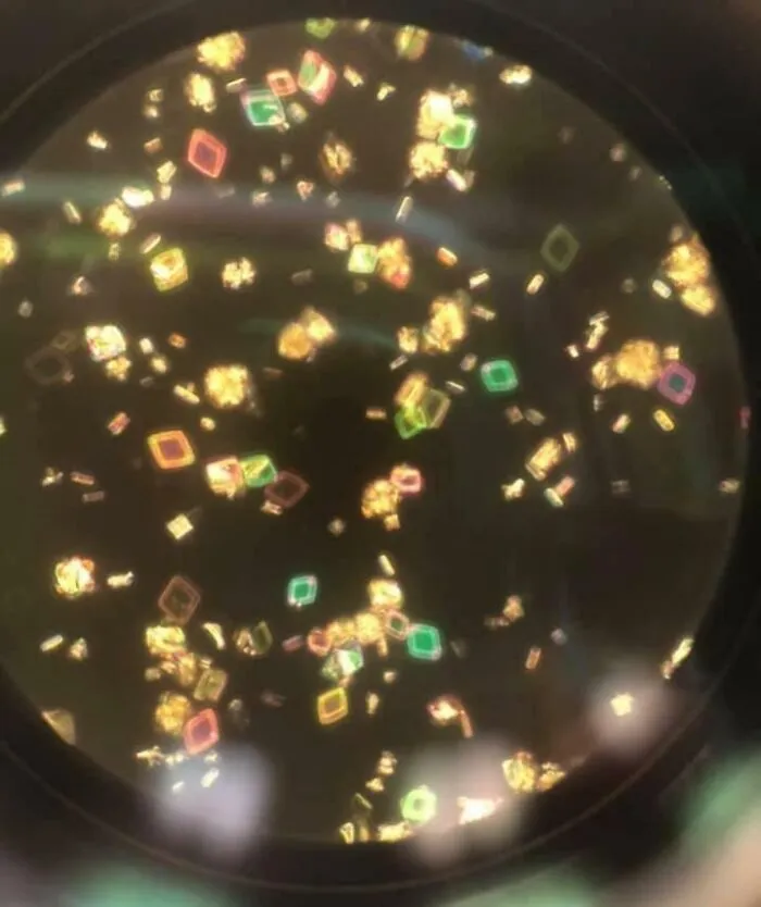 Uric Acid Crystals Of Urine Sample Seen Through A Microscope