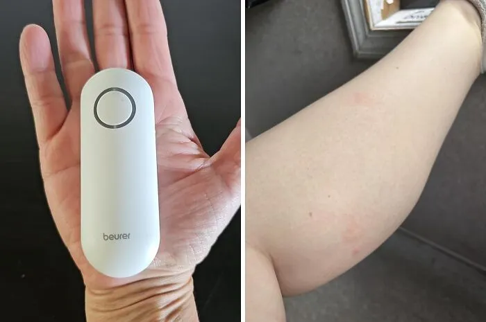 Because Those Itchy Mosquito Souvenirs Shouldn't Require A Chemistry Experiment To Soothe, This <a Style="Display:inline;" Href="Https://Www.amazon.com/Beurer-Br60-Chemical-Free-Treatment-Non-Toxic/Dp/B08mt4z89c?ie=utf8&th=1&linkcode=ll1&tag=bporca-20&linkid=81fb694f5f6f6bb03f7e14fbcf1c0db1&language=en_us&ref_=as_li_ss_tl" Target="_blank"><span Style="Font: Inherit; Color: #d74b1f;"> Non-Toxic Bug Bite Relief Tool</Span> Offers A Surprisingly Effective, Ouch-Free Fix
