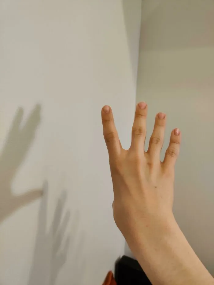 Nací sin pulgar en la mano derecha