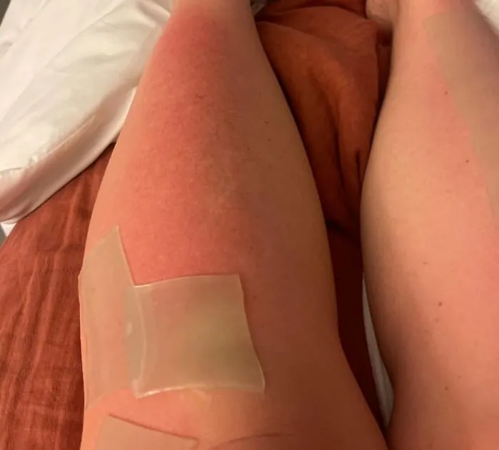 When Your Skin Is Screaming 'I Regret All My Life Choices That LED To This Sunburn,' This <a Style="Display:inline;" Href="Https://Www.amazon.com/Organic-Aloe-Sunburn-Relief-Termaburn/Dp/B0bvdcnznr?ie=utf8&linkcode=ll1&tag=bpkiwi-20&linkid=4826d0d29a0fcd8686882df560f760a6&language=en_us&ref_=as_li_ss_tl" Target="_blank"><span Style="Font: Inherit; Color: #d74b1f;"> Aloe Wrap For Sunburn Relief </Span> Is The Cooling, Soothing Hug It Desperately Needs