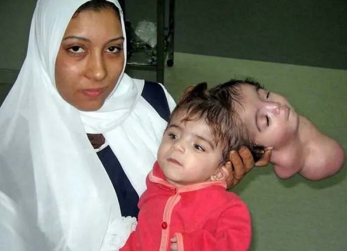 Woman holding a child with a rare congenital condition, showcasing one of the most fascinating content on the internet facts.