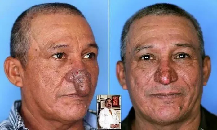 In 2021, Painter Conrado Estrada Suffered From Rhinophyma, A Condition That Caused His Nose To Become Large And Bulbous, Making It Difficult To Eat And Breathe