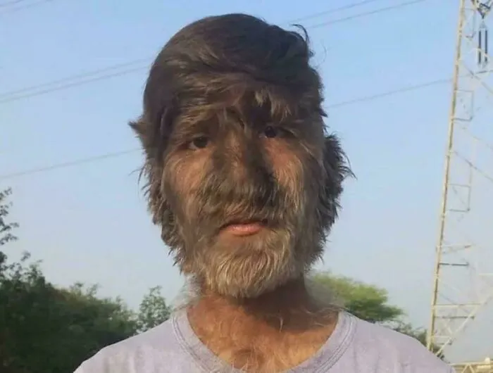 Young man with unique hair growth covering face, showcasing one of the most fascinating content on the internet facts.