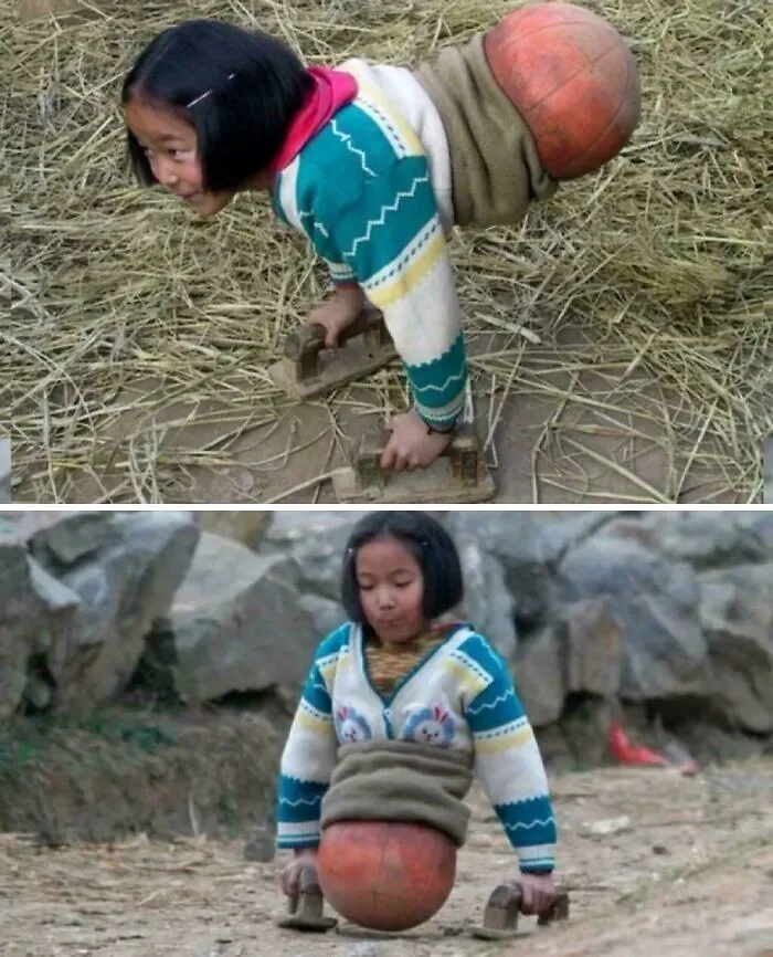 In 2000, Qian Hongyan Lost Her Legs In A Car Accident