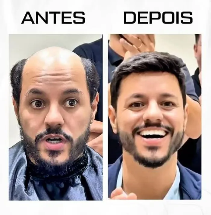 These 40 Men Got Non Surgical Hair Makeovers, And The Results Are Shockingly Natural Looking