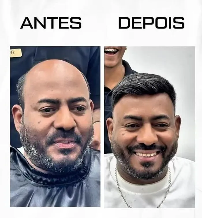 Before and after images showing a Brazilian stylist helping men with baldness restore their natural look and confidence.