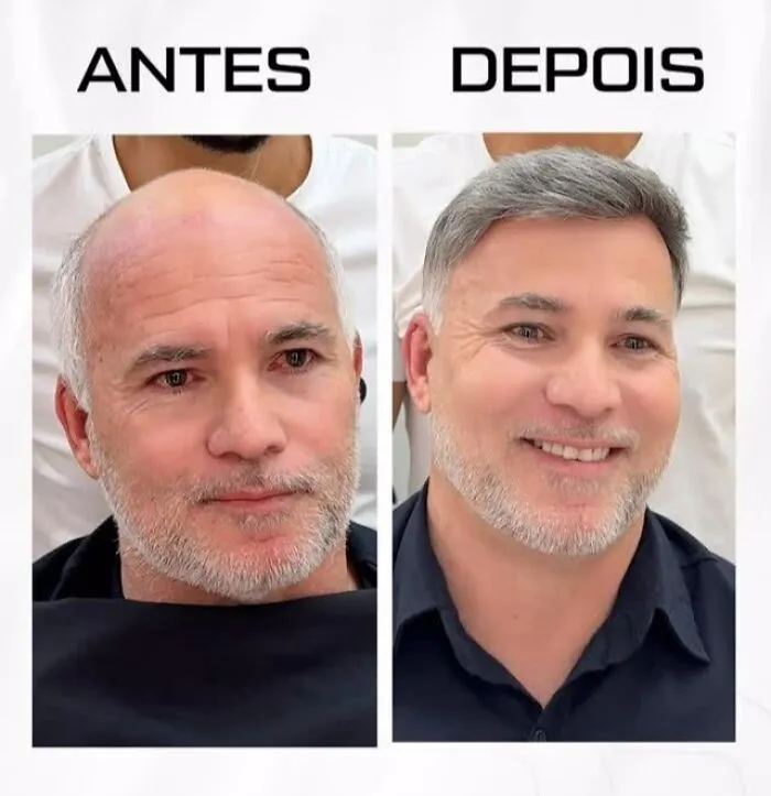 Before and after photos of a man with baldness restored by a Brazilian stylist, showing impressive hair transformation results.