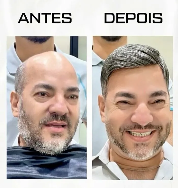 Before and after images showing a Brazilian stylist helping men with baldness regain their natural hair look.