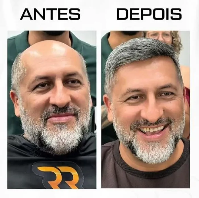 Side-by-side before and after images showing a Brazilian stylist's hair transformation for men with baldness.