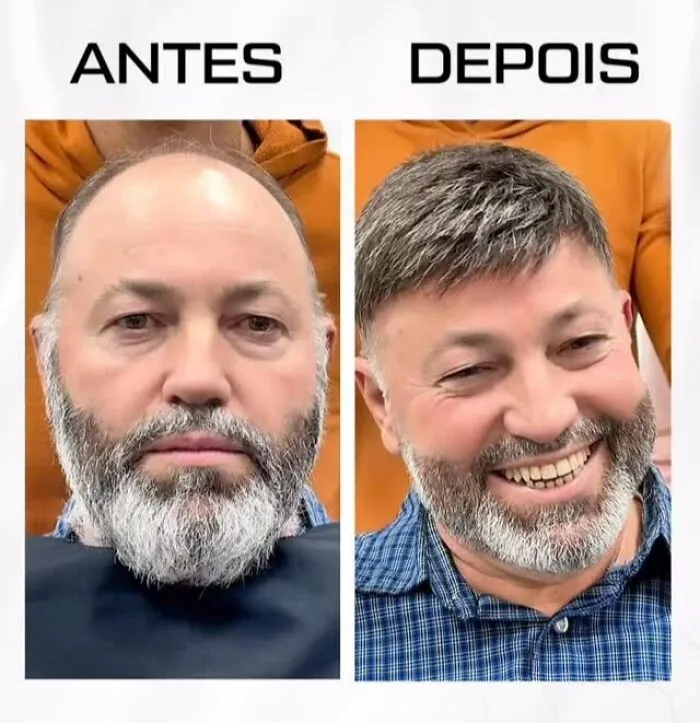 Before and after images showing Brazilian stylist's impressive results helping men with baldness look like themselves again.