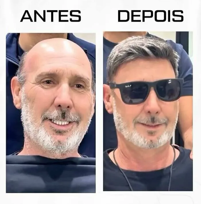 Before and after image showing a Brazilian stylist helping a man with baldness look like himself again.