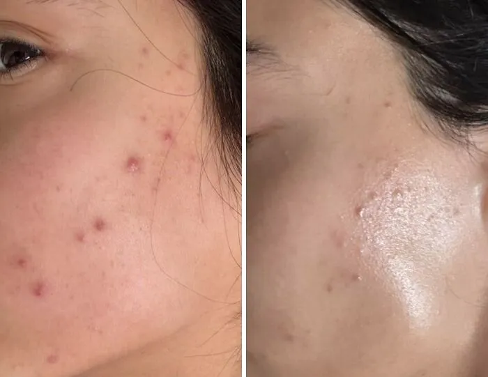Your Face Can Finally Ghost Those Pesky Breakouts With The Help Of<a Style="Display:inline;" Href="Https://Www.amazon.com/Differin-Adapalene-Treatment-60-Day-Supply/Dp/B07hkvbrcf?ie=utf8&th=1&linkcode=ll1&tag=bppelican-20&linkid=dbed2a1f3d7657f35a8e9509b2d31cbc&language=en_us&ref_=as_li_ss_tl" Target="_blank"> <span Style="Font: Inherit; Color: #d74b1f;"> Differin Acne Treatment Gel </Span>