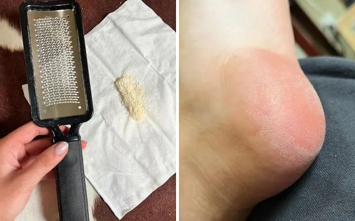 Give Your Feet The Ultimate Satisfying Glow-Up By Grating Away Those Rough Patches With A <a Style="Display:inline;" Href="Https://Www.amazon.com/Colossal-Remover-Pedicure-Surgical-Stainless/Dp/B00vpvevsk?ie=utf8&linkcode=ll1&tag=bppelican-20&linkid=372c08a48fa400185b29d131757cf11b&language=en_us&ref_=as_li_ss_tl" Target="_blank"> <span Style="Font: Inherit; Color: #d74b1f;"> Colossal Foot Rasp </Span>
