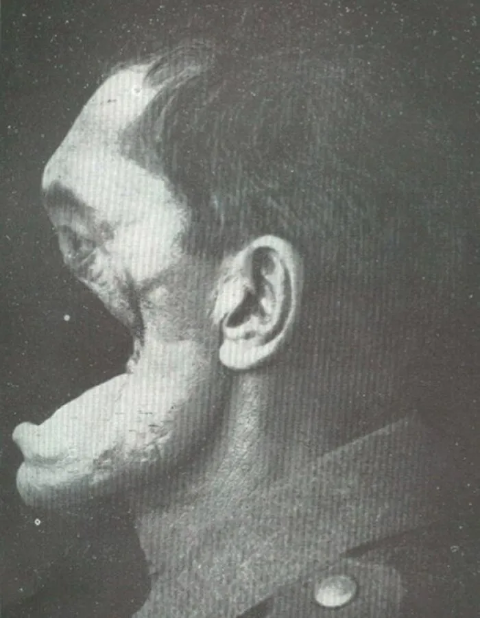 Horrifying (And Nearly Fatal) Facial Injuries To A German Soldier In World War I (1914-1918)